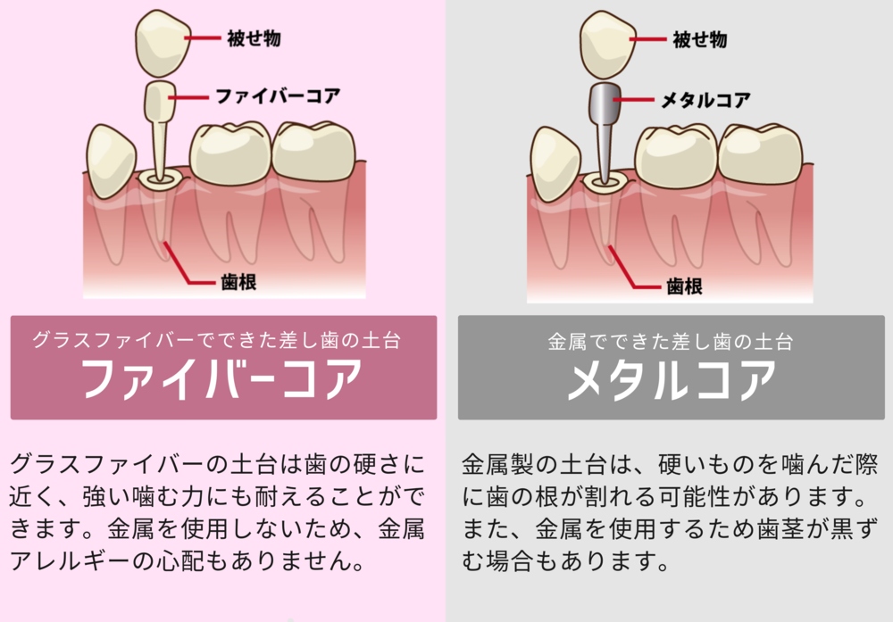 ファイバーコアとメタルコアの違い