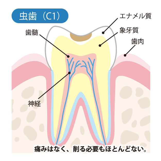 C1　エナメル質の中のむし歯