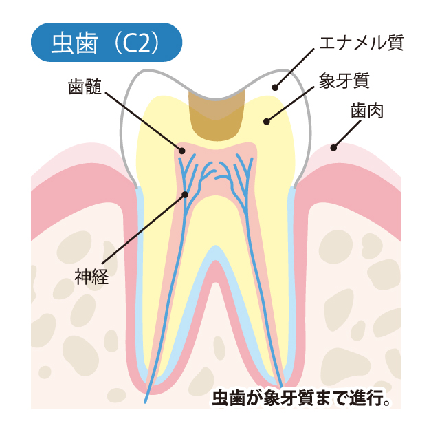 C2　象牙質に達したむし歯