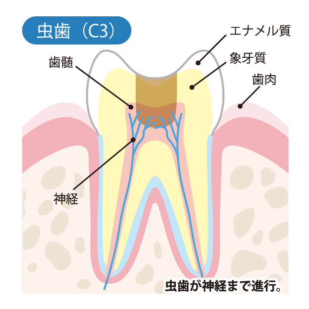C3　神経 (歯髄)に達したむし歯