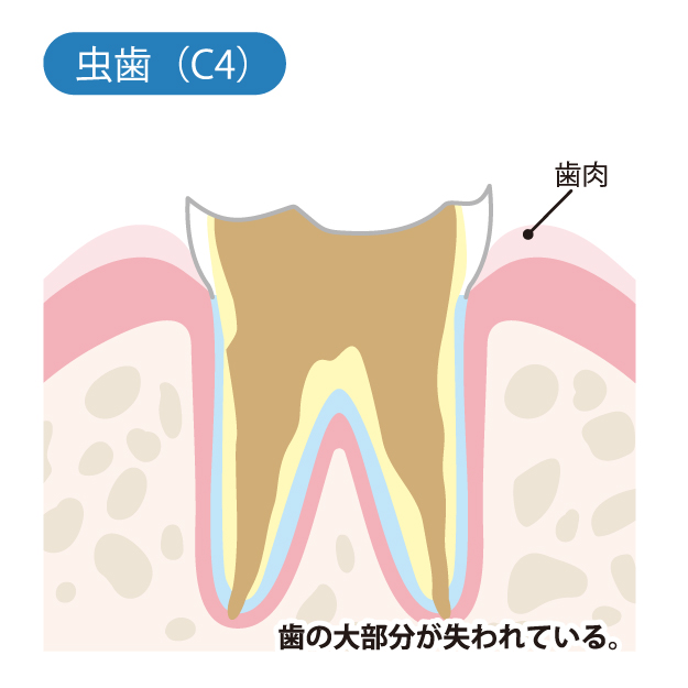 C4　歯質が失われたむし歯