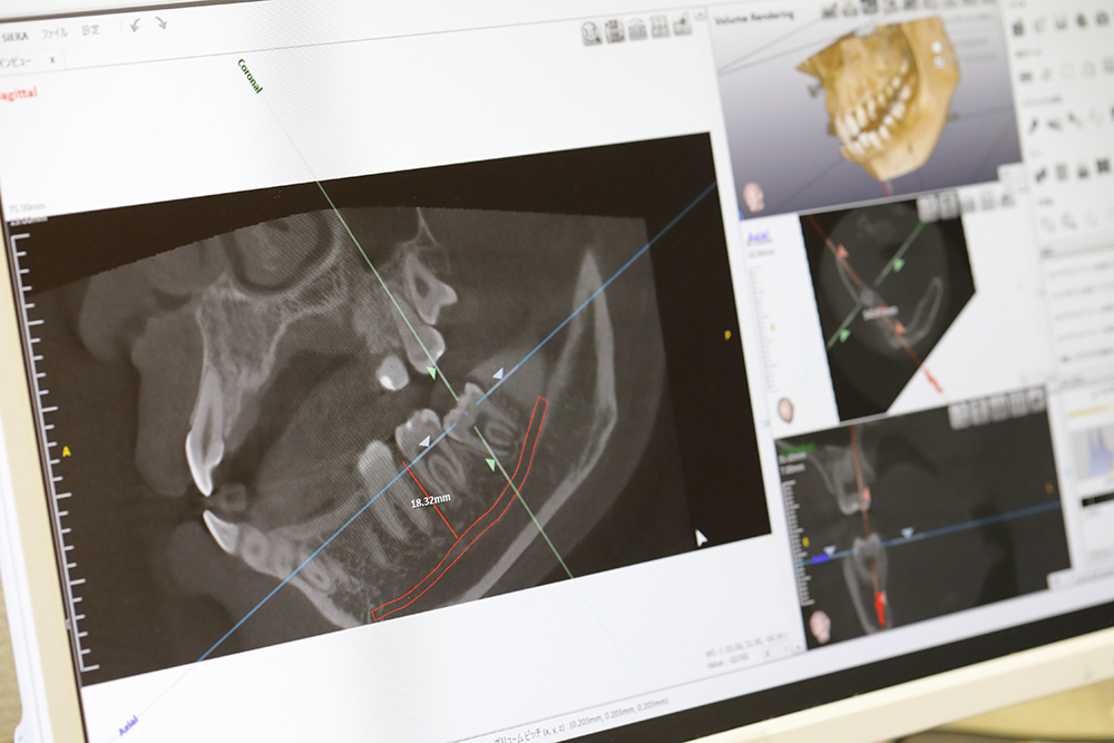 歯科用CTを用いた精密な診査・診断