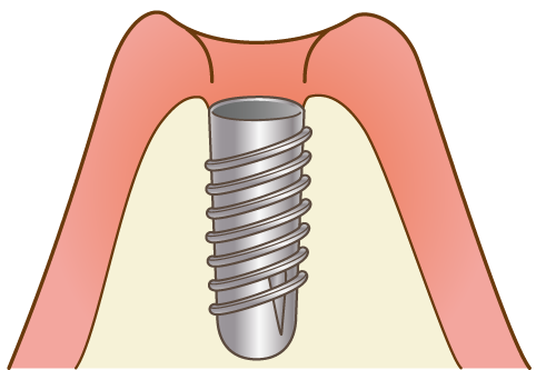 インプラント埋入（一次手術）