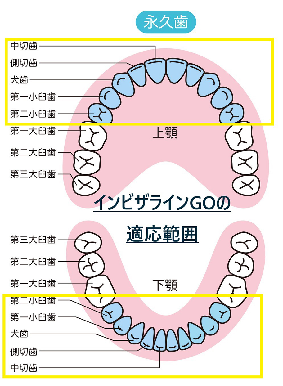 適応範囲は小臼歯まで