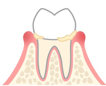 歯肉炎(歯周病の初期段階)