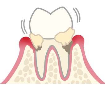 軽度歯周病