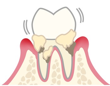 中度歯周病
