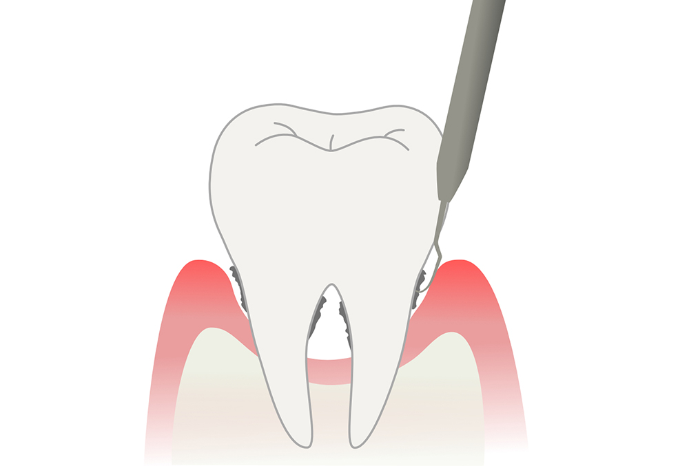 SRP（歯石除去）