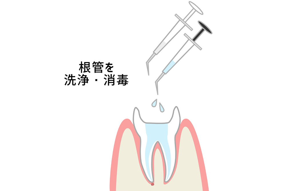 「EDTA」「次亜塩素酸ナトリウム」による洗浄・消毒