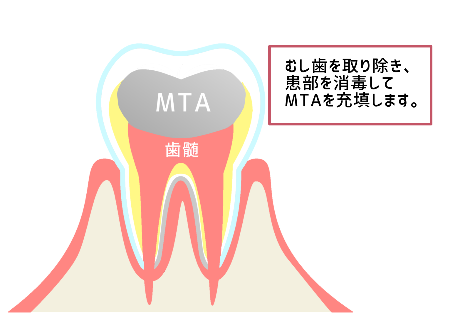 歯髄保存療法（MTA）