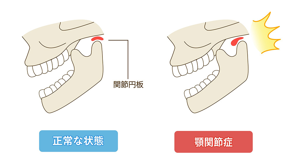 顎関節症