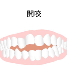 開咬