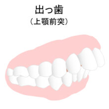 出っ歯